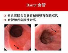 食道炎吃什么药效果最佳